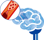 허혈성 뇌졸중 아이콘